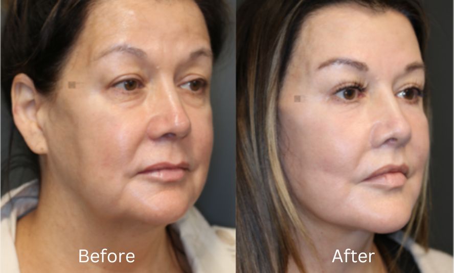 Halo laser treatment before and after oakville