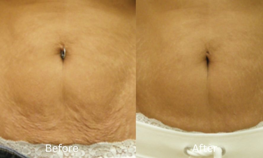 stretch mark and sagging skin treatment oakville